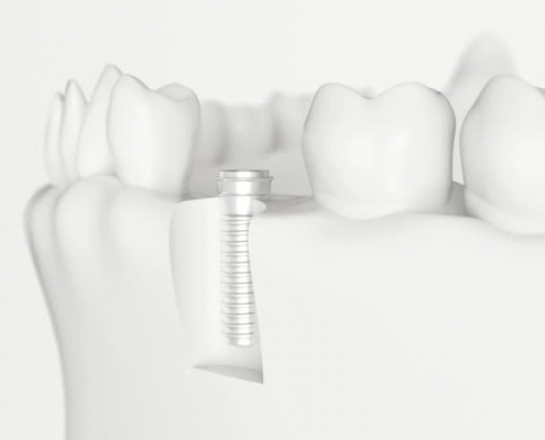 implant dentaire hay riad rabat